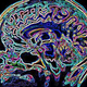 Illustration for article titled Another once-promising Alzheimer's treatment goes down the tubes